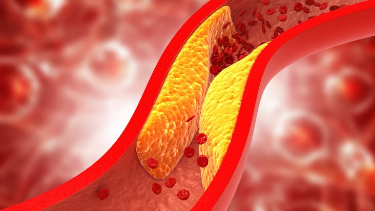 Understanding the Link Between High Cholesterol and CVD